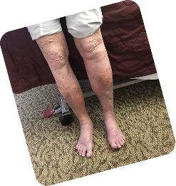 Skin Changes (Stage 4)