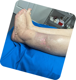 Venous Ulcers & Chronic Wounds (Stage 5 & 6)