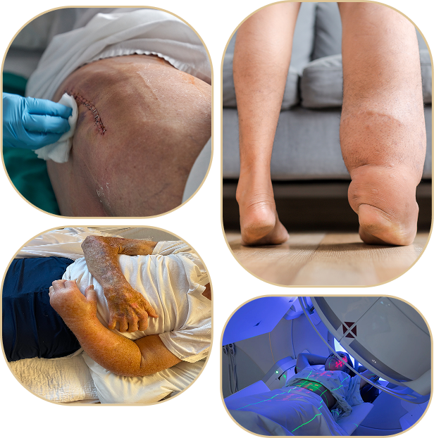 How Does Lymphedema Occur?