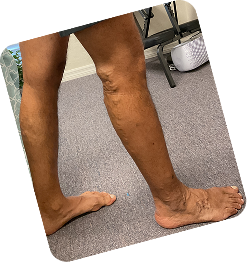 Spider Veins (Stage 1) & Varicose Veins (Stage 2)